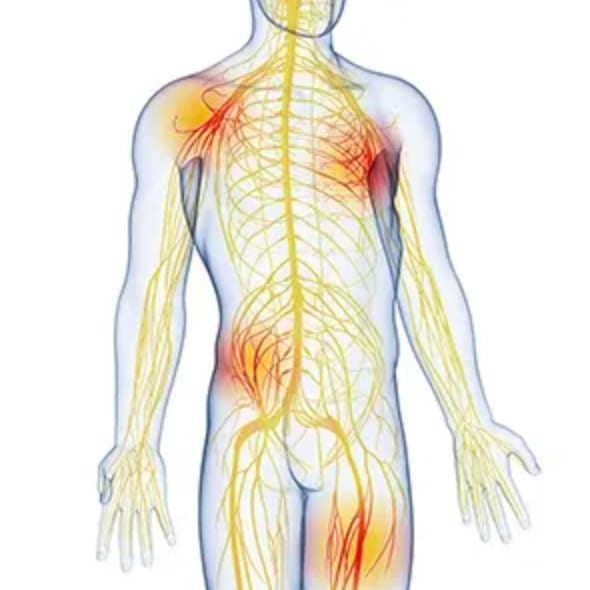 Illustration of nerve pain caused by impingement, often linked to poor posture