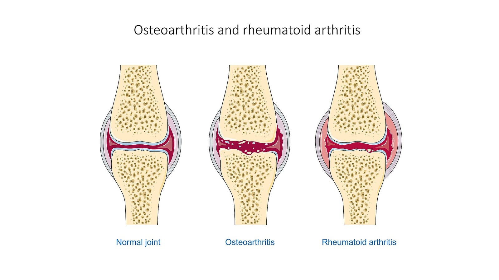 FREE Seminar: Osteoarthritis — It's Not Just Wear & Tear (plus Pau Hana Gathering)